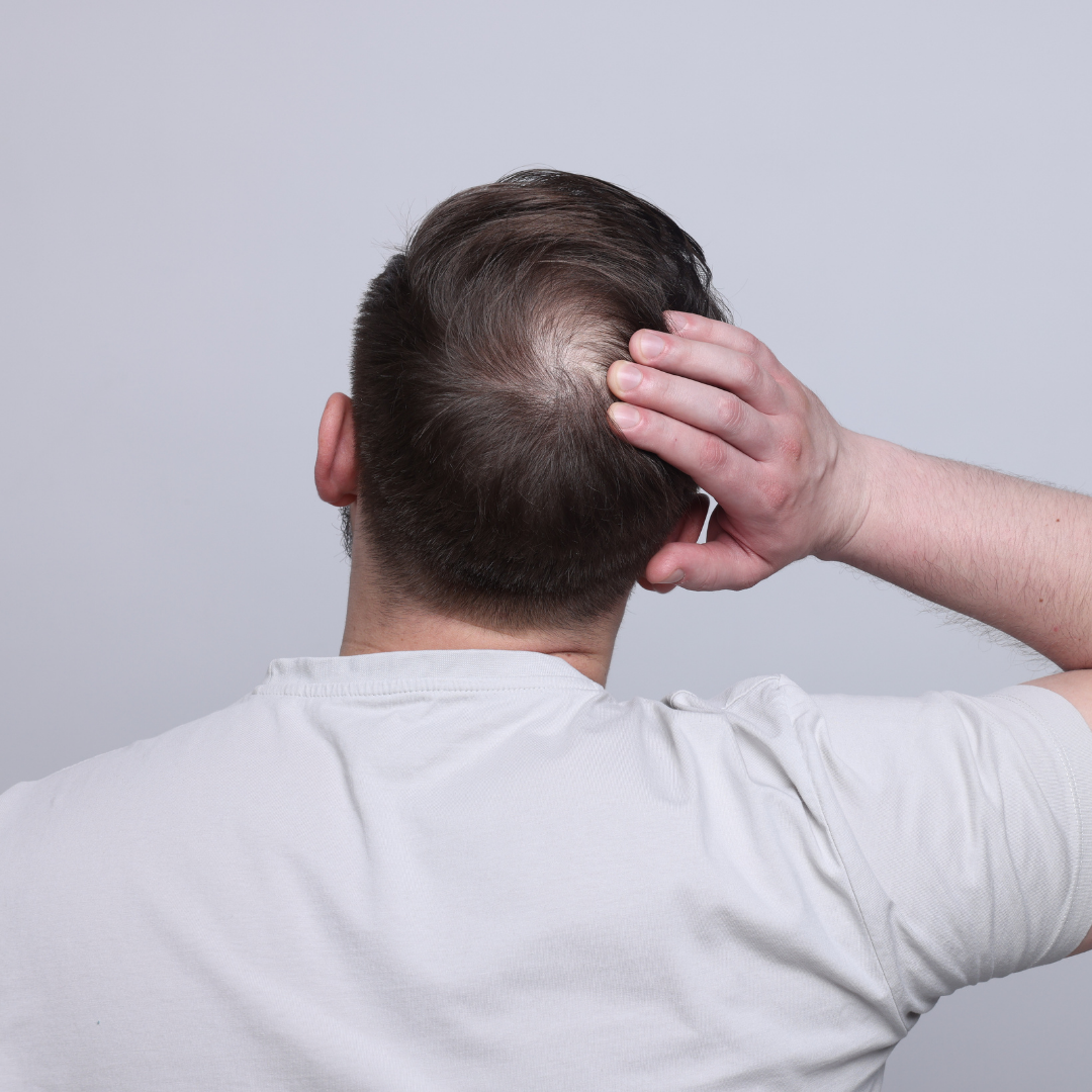 hair loss treatment and male fertility